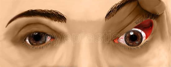 Floppy eyelid syndrome — easily everted upper eyelid