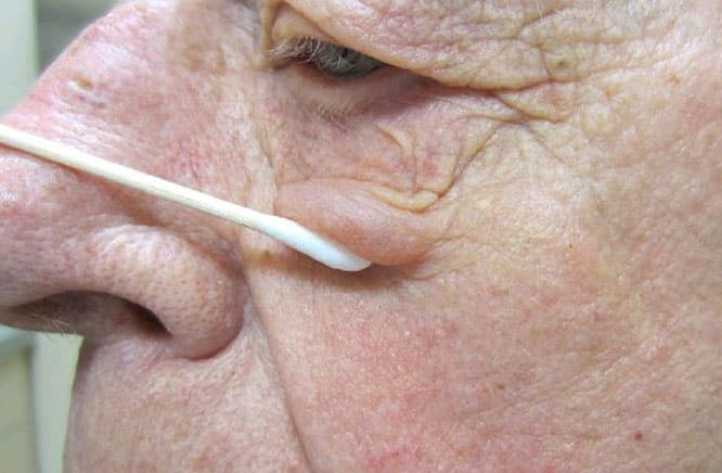 Rosacea โ periocular involvement