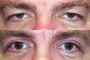 Before and after images of a 52-year-old patient showing ptosis and blepharoplasty outcomes.
