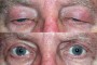 Before and after images of a 72-year-old patient who underwent ptosis and blepharoplasty procedures, sourced from the National Database.