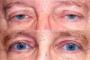 Before and after images of a patient undergoing ptosis and blepharoplasty procedures.