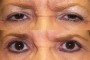Before and after image showing Ptosis and Blepharoplasty. Text on the image reads '58y Before/After (From National Database) Ptosis and Blepharoplasty'