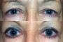 Before and after images of a 48-year-old patient who underwent ptosis and blepharoplasty procedures. From the National Database.