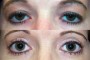 Before and after images of a 34-year-old patient showing ptosis and blepharoplasty. (From National Database)