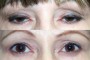 Comparison image showing a before-and-after view of a 45-year-old patient who underwent ptosis and blepharoplasty procedures. From the National Database.
