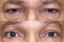 Before and after image of a 52-year-old patient undergoing ptosis and blepharoplasty, sourced from the National Database