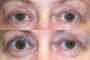 Before and after images of a 61-year-old patient showing the results of ptosis and blepharoplasty surgery from the national database