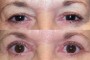58-year-old patient before and after ptosis and blepharoplasty surgery, from National Database